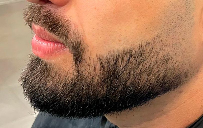 Barba piora espinhas? Entenda mais sobre essa relacao!